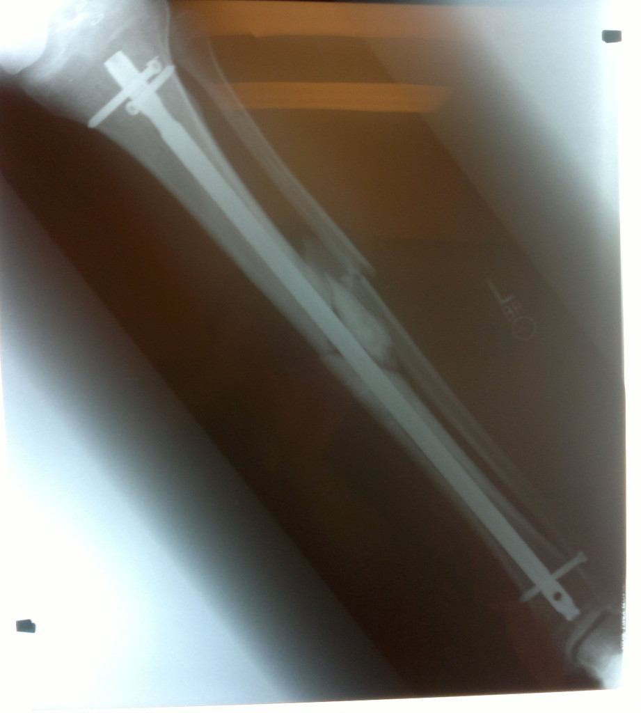 x-ray of shatter femur with rod